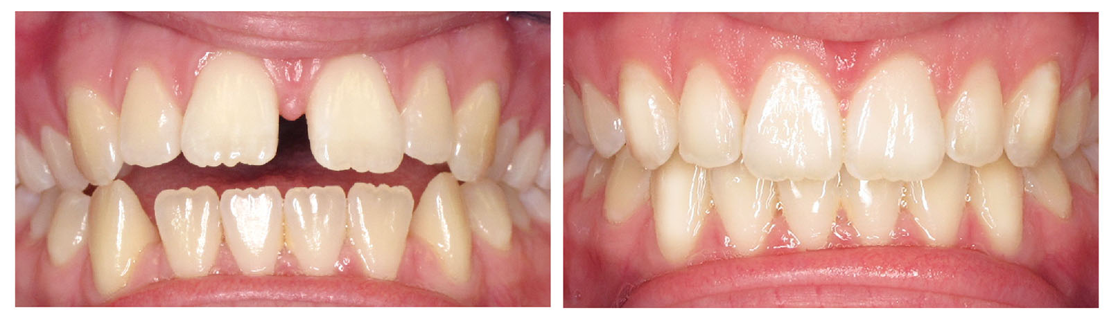 West Chicago Smiles | Preventative Program, All-on-6 reg  and Implant Dentistry