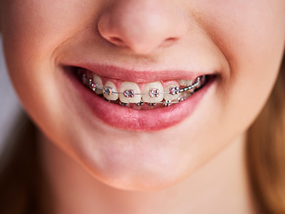 A smiling young person with braces, showcasing a bright smile and clear teeth.