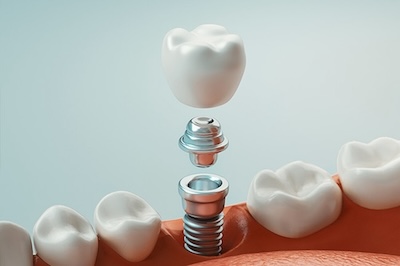 A close-up of a tooth with a small screw inserted into it, placed next to a mouth model with teeth and gums.