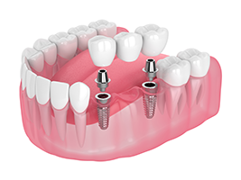 West Chicago Smiles | Dental Fillings, Oral Exams and Air Abrasion