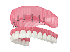 West Chicago Smiles | Preventative Program, Air Abrasion and CEREC