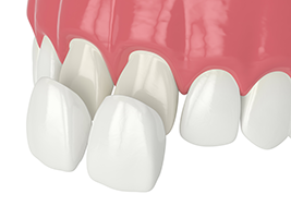 West Chicago Smiles | Oral Exams, CEREC and Fluoride Treatment