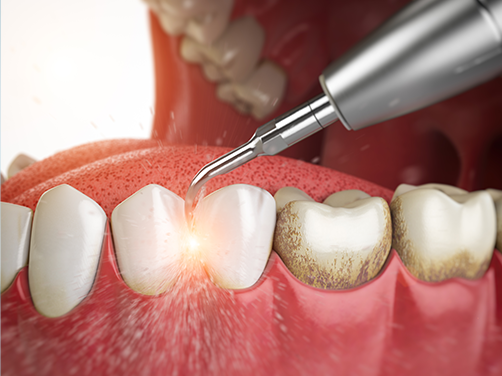 West Chicago Smiles | Oral Exams, Digital Impressions and All-on-6 reg