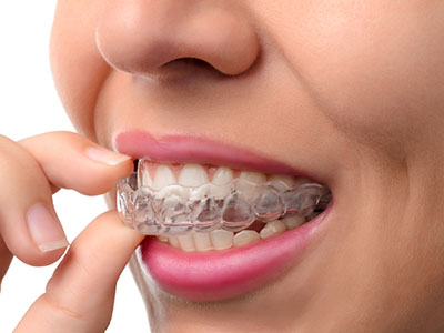 West Chicago Smiles | Fluoride Treatment, Night Guards and Dermal Fillers
