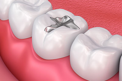 The image displays a 3D rendering of a dental implant being inserted into a tooth socket, with visible teeth on either side and a pink gum background.