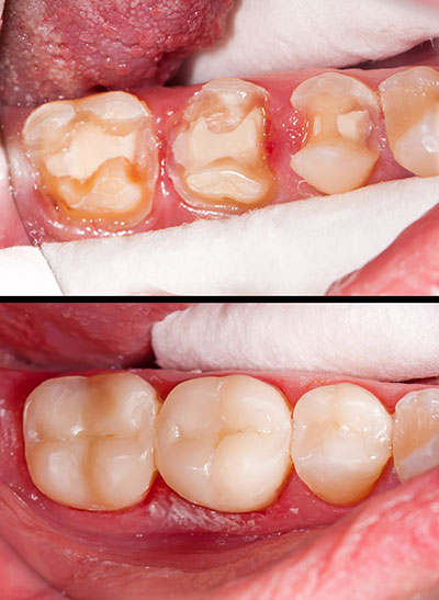 The image displays a close-up of a person s open mouth with visible dental decay and missing teeth, showing the upper and lower teeth in need of repair or replacement.