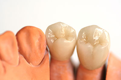 The image displays a set of artificial teeth and gums with a focus on the dental implants, showcasing their design and structure.