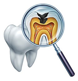 The image shows a magnified view of a tooth with an open crown, where the pulp chamber is visible and appears to contain a dark, possibly decayed, substance. A dental mirror with a magnifying glass is held up to the tooth, focusing on the pulp chamber, which is highlighted in red to indicate inflammation or infection. The image is educational and is likely used to illustrate dental issues related to the pulp chamber of a tooth.