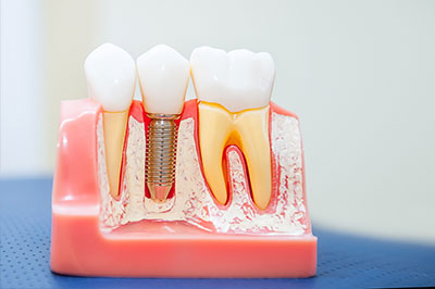 An image of a dental model with teeth and gums, featuring a metal implant and a pink plastic base.