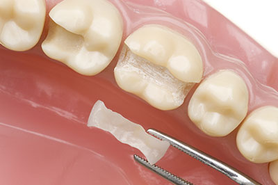 Dental implant procedure in progress, showing a tooth with an implant post and a small piece of bone graft material.