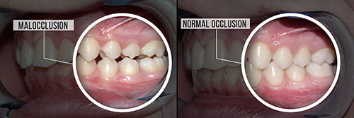 The image shows a side-by-side comparison of a person s teeth before and after a dental procedure, with labels indicating  Malocclusion  and  Normal occlusion,  highlighting the improvement in tooth alignment.