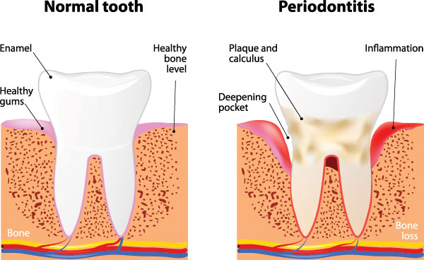 The image is a medical illustration showing the normal tooth structure and three stages of gum disease progression, labeled as  periodontitis,  with annotations pointing to bone loss and inflammation.