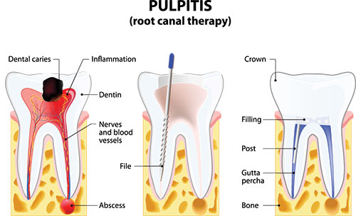 The image is a diagrammatic illustration of the pulpitis process in dental care, showing a tooth with a visible crack and infection, labeled with terms such as  crown,   dentin,   neck,   root canal therapy,  and  file.