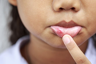 The image depicts a close-up of a young child s face with a finger placed on their lips, and the child appears to have a small, red bump or spot near their mouth.