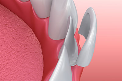 The image shows a close-up of a dental implant with a pink gum background and a metallic screw visible.