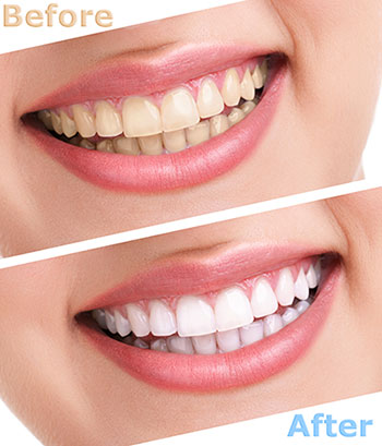 The image features a side-by-side comparison of a person s teeth before and after dental treatment, showcasing the results of teeth whitening.