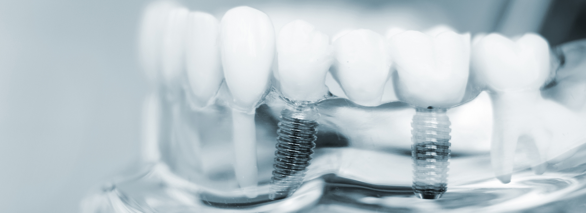 The image shows a close-up of a dental implant with screws and abutments, likely for educational or promotional purposes.