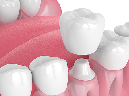 West Chicago Smiles | Full Mouth Reconstruction, Dentures and Air Abrasion