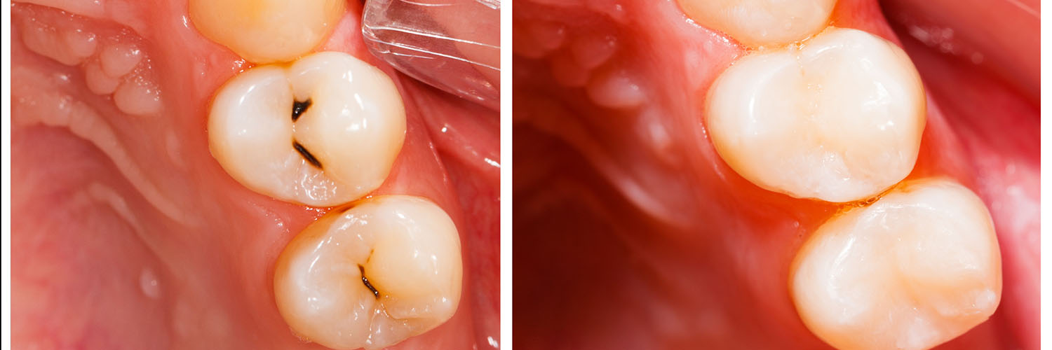 West Chicago Smiles | Pediatric Dentistry, Digital Impressions and Periodontal Treatment
