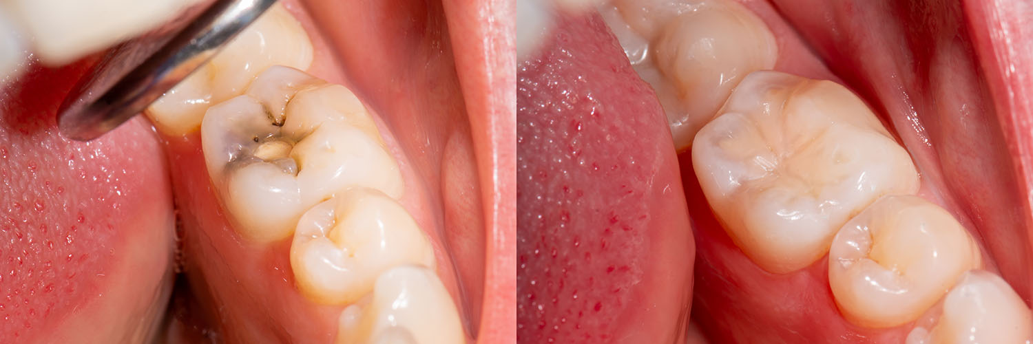 West Chicago Smiles | Digital Impressions, Preventative Program and Dental Bridges